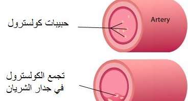 تصلب الشرايين: تعريف وأسباب