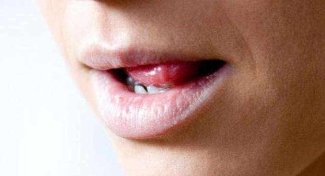 علاج كثرة اللعاب عند الحامل