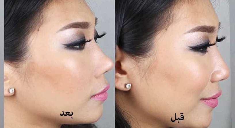تقنية لرفع الأنف من دون عملية جراحية