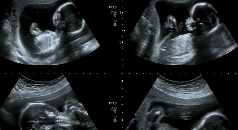 متى يظهر نوع الجنين بوضوح