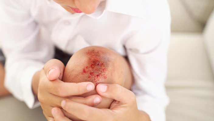 كيفية علاج الكدمات بطرق طبيعية