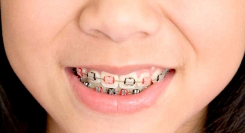 تقويم اسنان الاطفال 