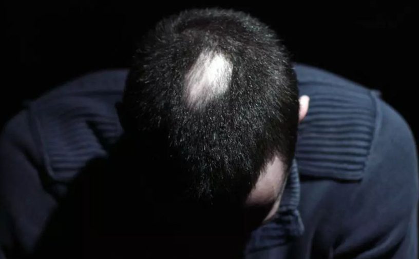 تعرفي الى اسباب مرض ثعلبة الشعر وطرق العلاج الطبيعية!