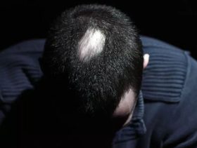 تعرفي الى اسباب مرض ثعلبة الشعر وطرق العلاج الطبيعية!
