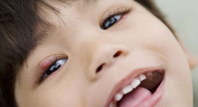 علاج شحاذ العين عند الاطفال