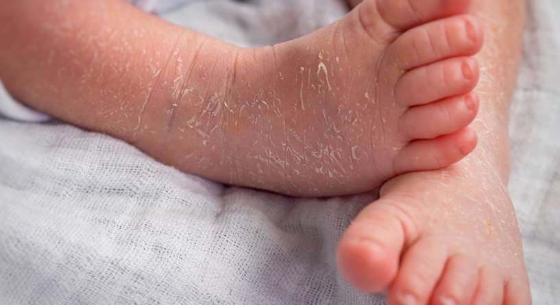 مرض السماك والعلاج الفعال