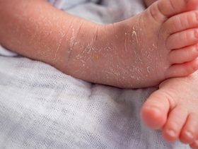 مرض السماك والعلاج الفعال