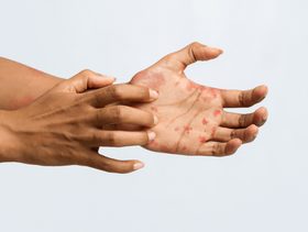 مرض الفطر الأسود